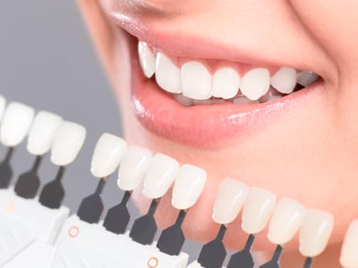 Porcelain Veneers - Dr. Sun's In-House Lab can give you a perfect match