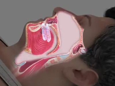 Oral sleep appliances are a great non-invasive alternative for treating OSA (Obstructive Sleep Apnea) or sleep related breathing disorders, such as UARS (Upper Airway Resistance Syndrome) and snoring (Click or Tap anywhere to close window)
