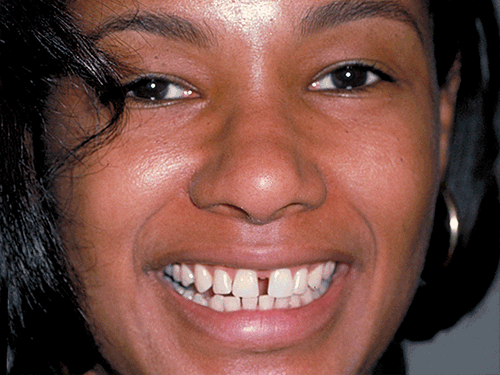 Stephanie had an unsightly large gap between her two top front teeth. The solution: All of Stephanie's top front teeth were bonded, distributing the spaces between teeth, to achieve the proper proportion for the two front teeth (Click or Tap anywhere to close window)