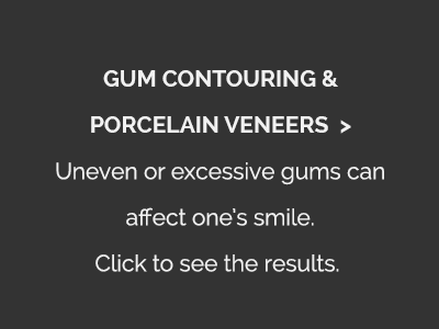 GUM CONTOURING & PORCELAIN VENEERS