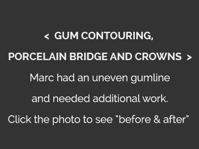 Gum Contouring, Porcelain Bridge and Crowns