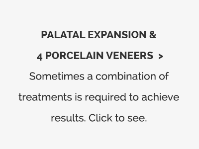 Palatal Expansion and Veneers